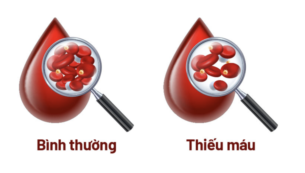 Bệnh thiếu máu là gì? Dược sĩ Đạt 