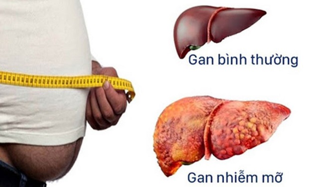 Bệnh gan nhiễm mỡ là gì? Dược sĩ Đạt 