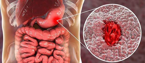 Viêm loét dạ dày là gì? Dược sĩ Đạt 