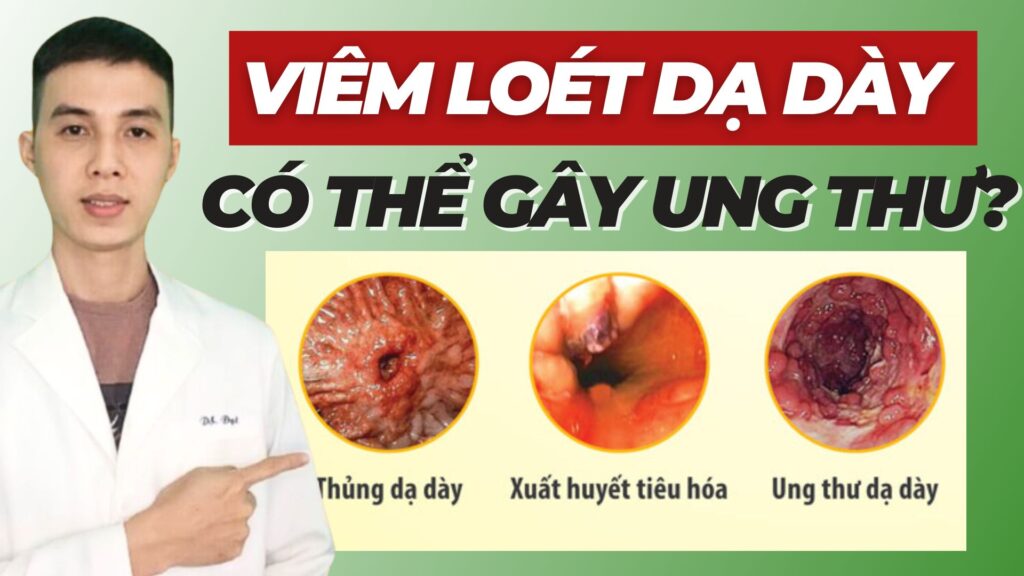 Viêm loét dạ dày có thể gây ung thư Dược sĩ Đạt